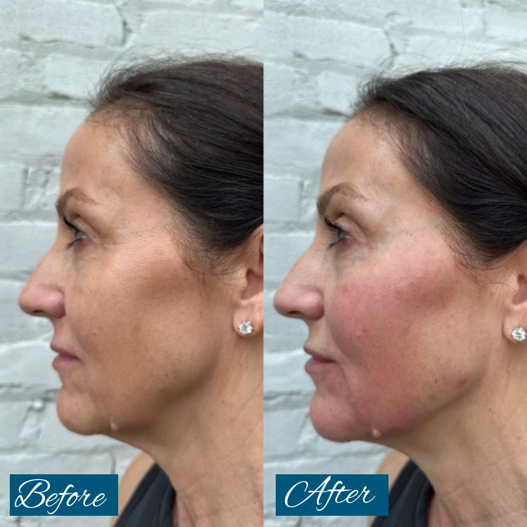 Before and after side profile showing lifted cheeks and improved facial contour from cheek and jaw filler