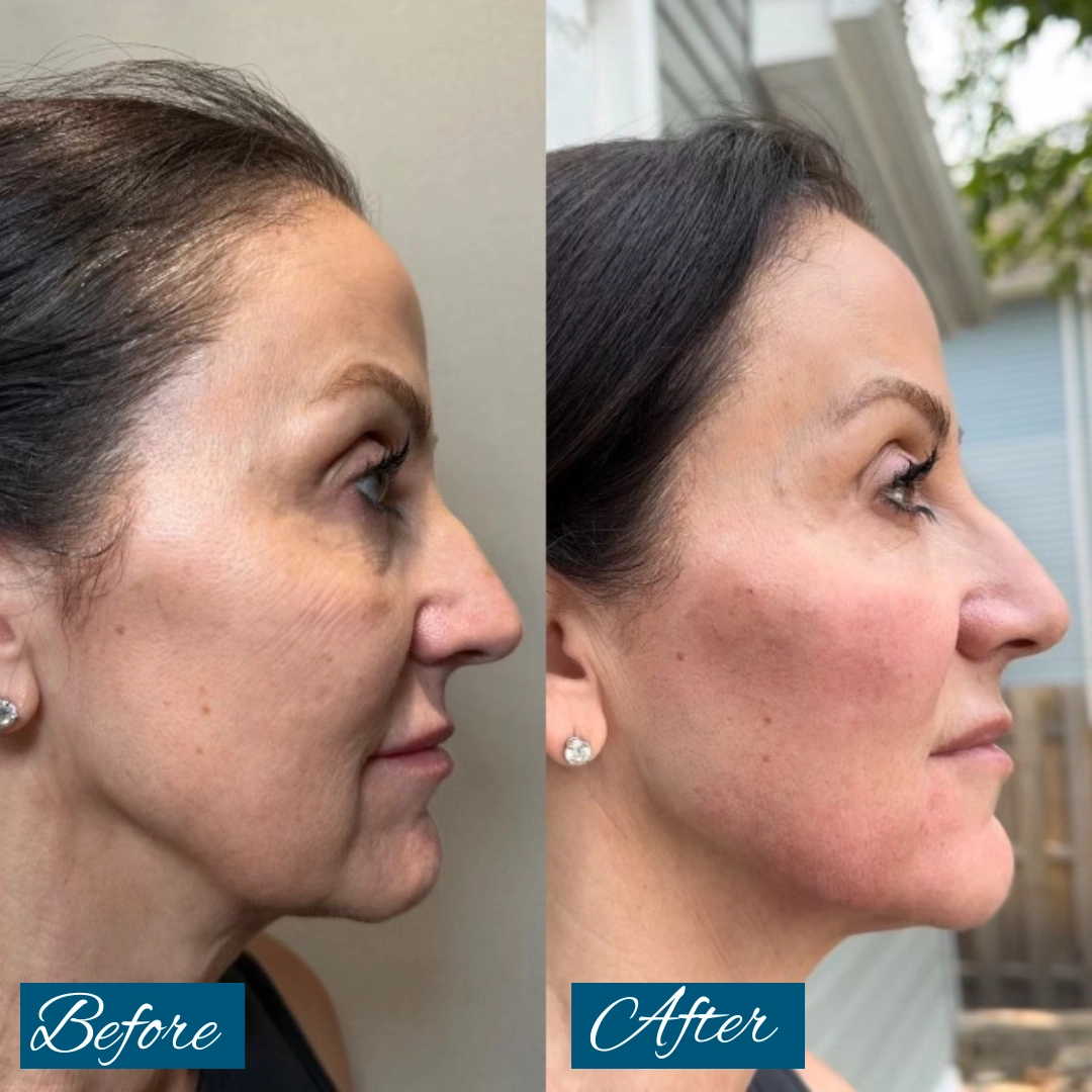 Before and after side profile showing enhanced cheekbones and jawline definition from cheek and jaw filler