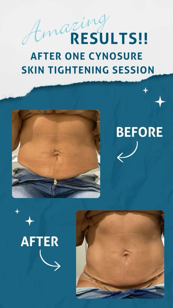 Abdomen before and after one Cynosure skin tightening session showing reduced appearance of loose skin