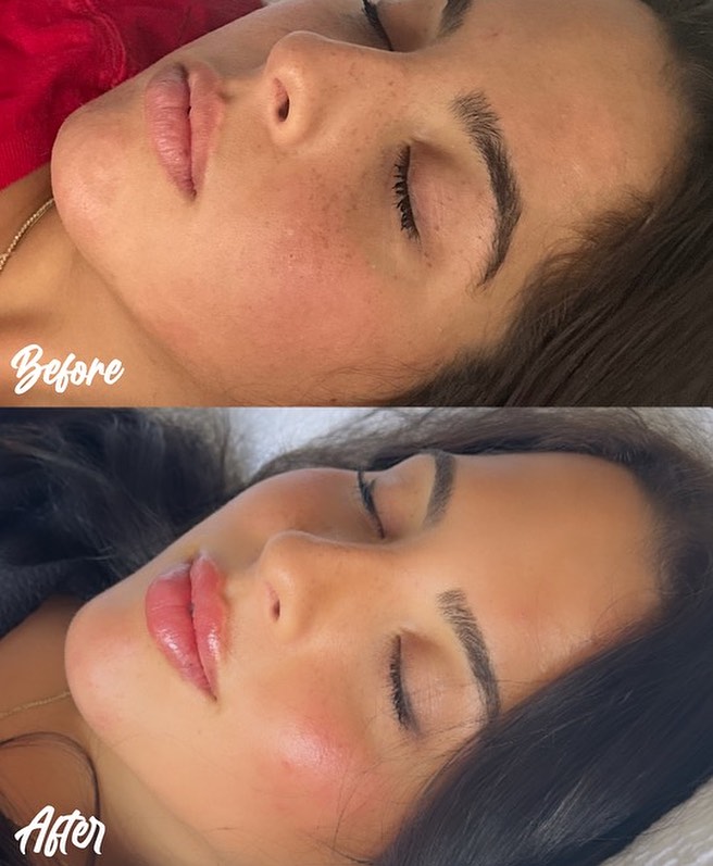 Before and after lip rejuvenation showing enhanced lip fullness and color with improved definition