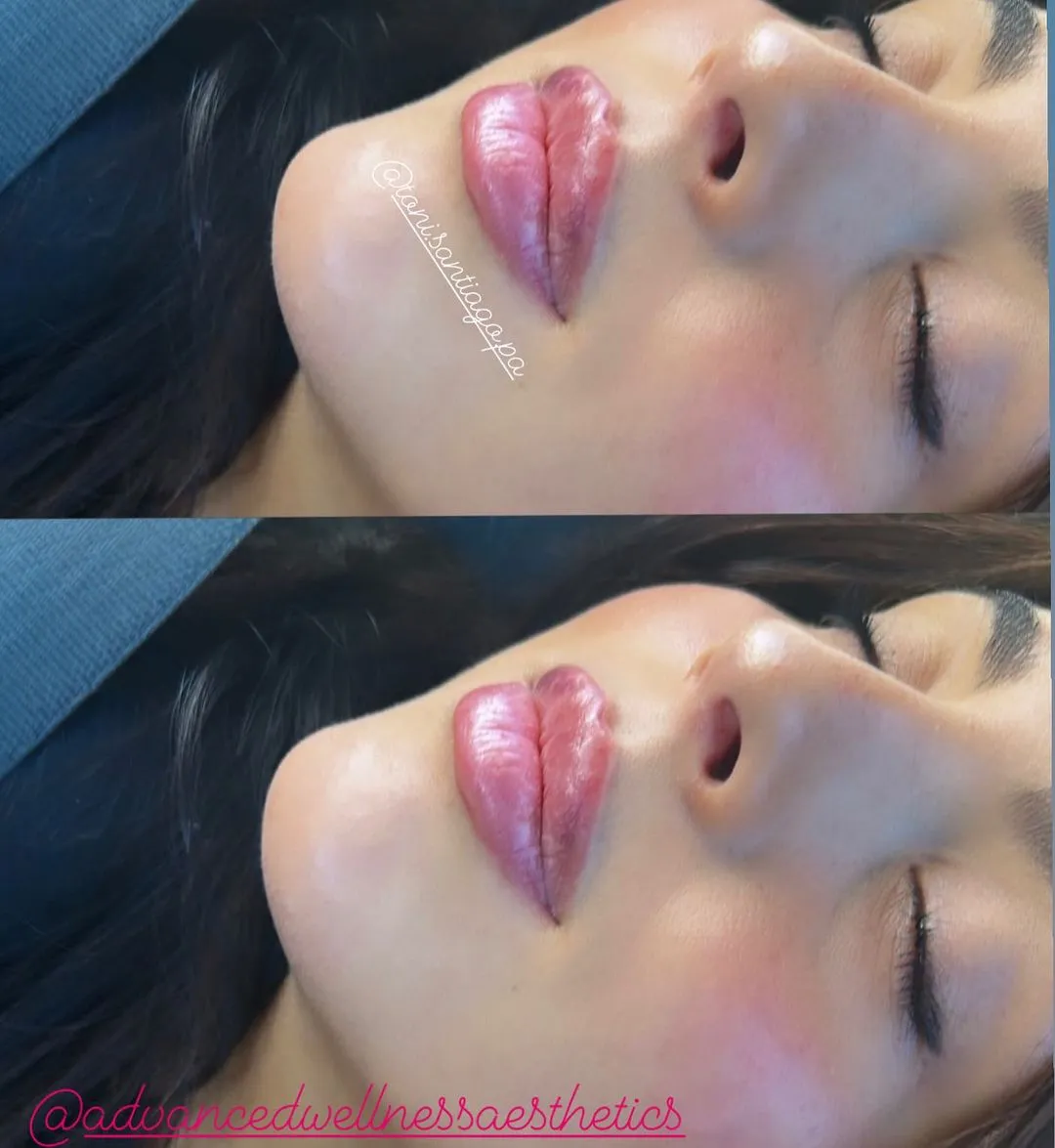Lip filler results showing fuller, more defined lips with enhanced volume