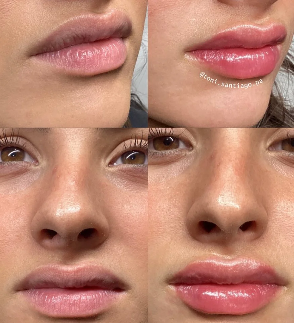 Before and after lip and under-eye filler results by Toni Santiago showing fuller lips and reduced under-eye hollowing