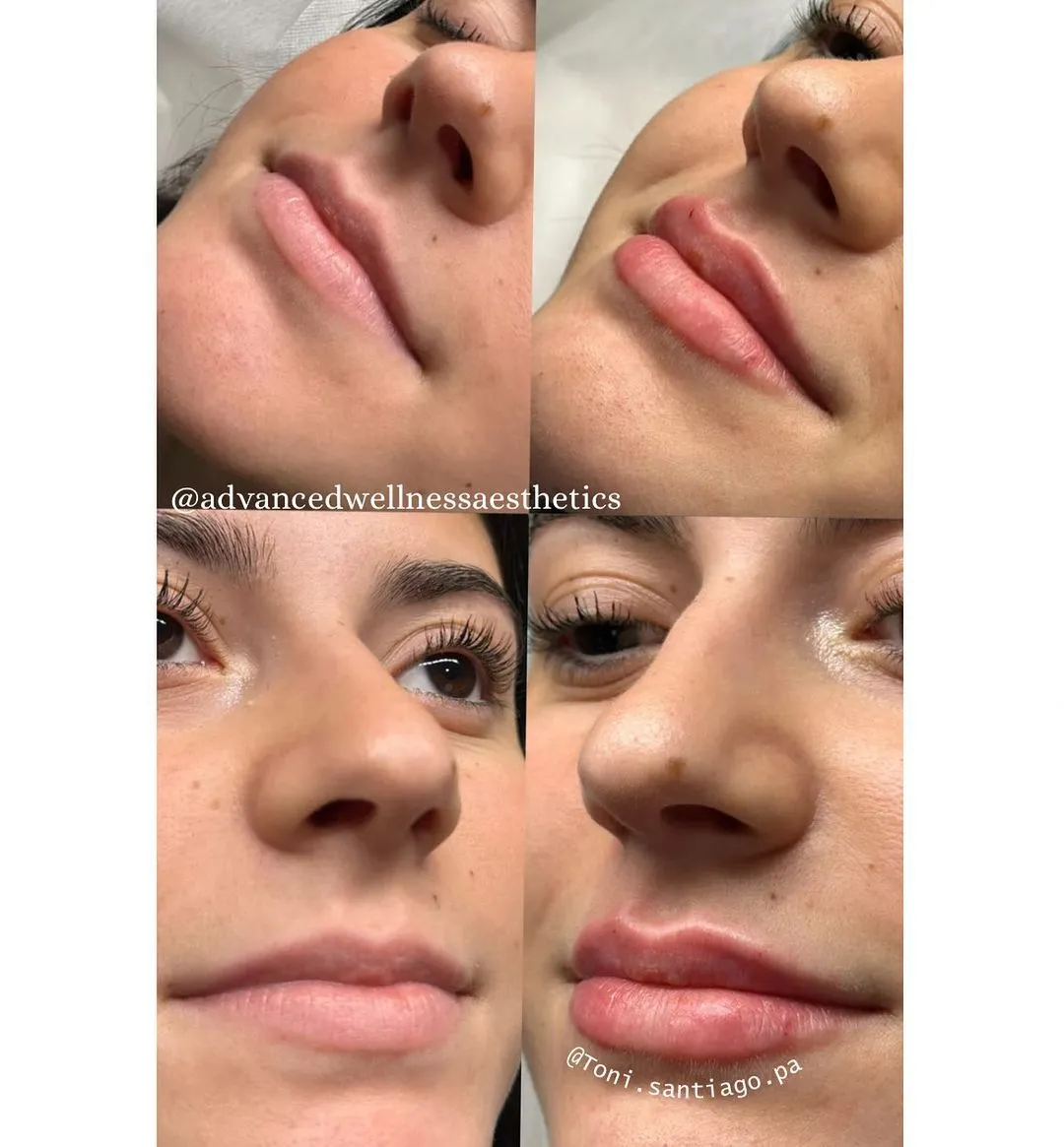 Before and after lip filler results showing increased fullness from side and frontal angles
