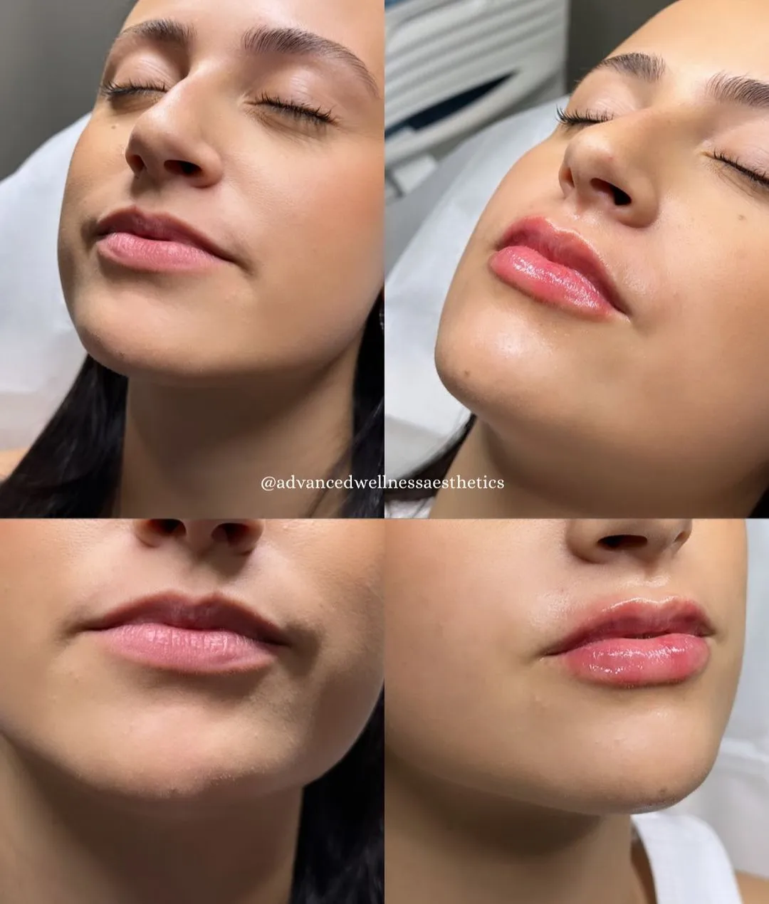 Before and after lip filler case showing enhanced lip volume and definition from profile view