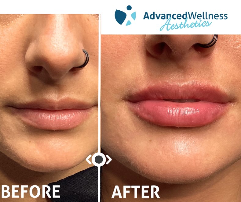Before and after lip filler comparison with Advanced Wellness Aesthetics logo, showing increased lip fullness