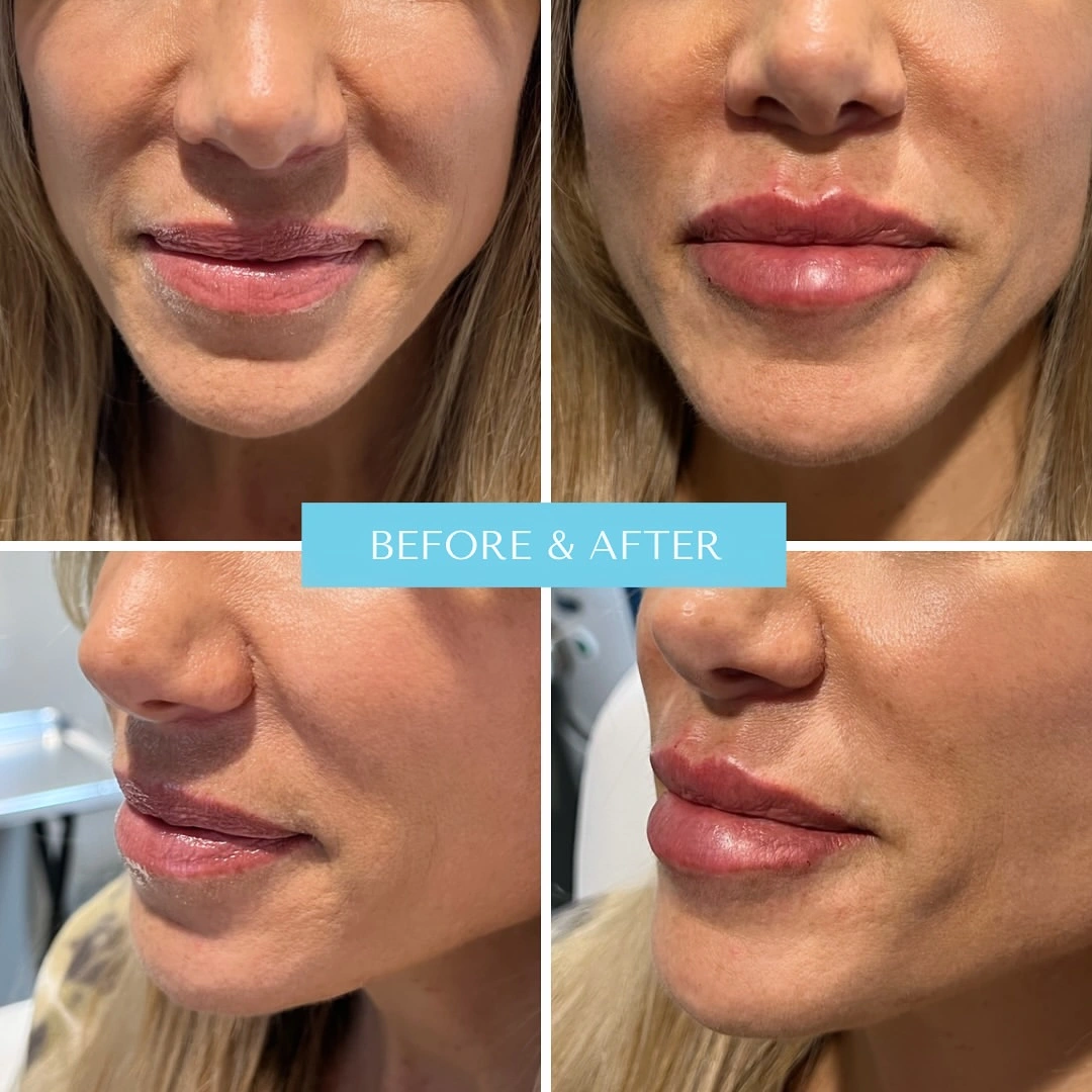 Before and after lip filler showing fuller, more defined lips from multiple angles