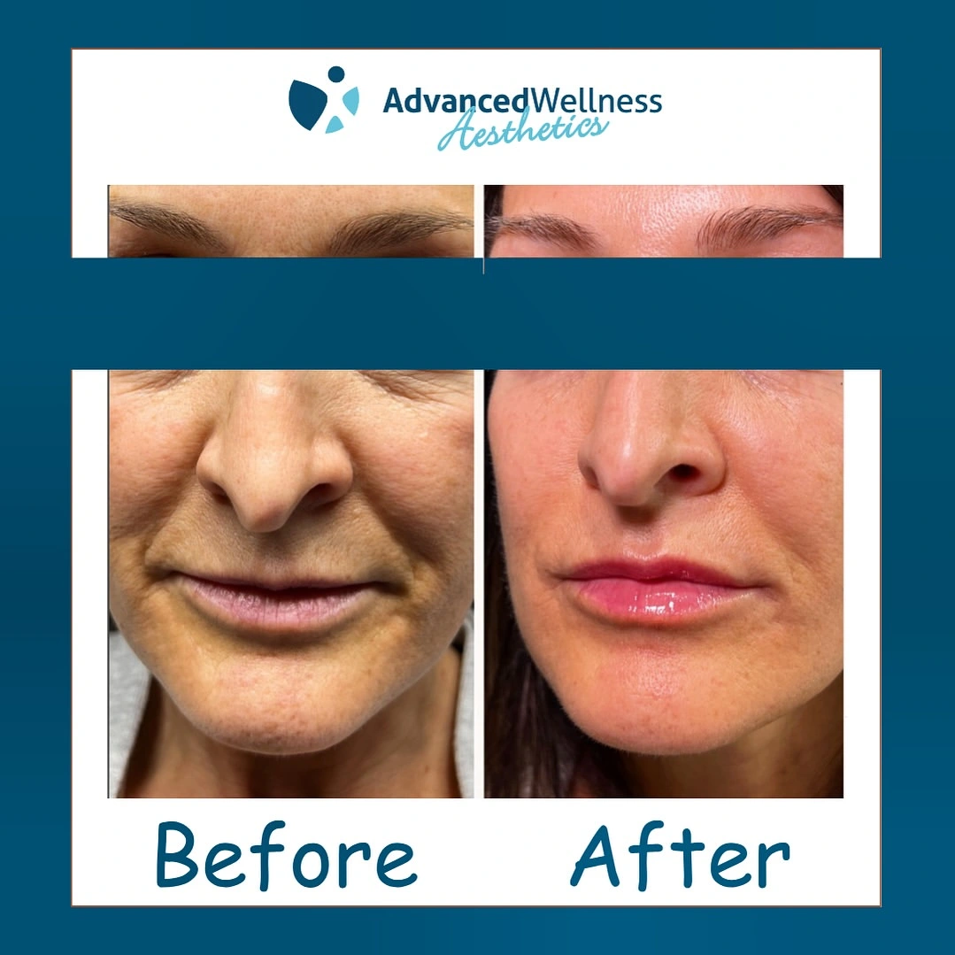 Before and after PDO thread and lip filler treatment showing lifted lower face and fuller lips