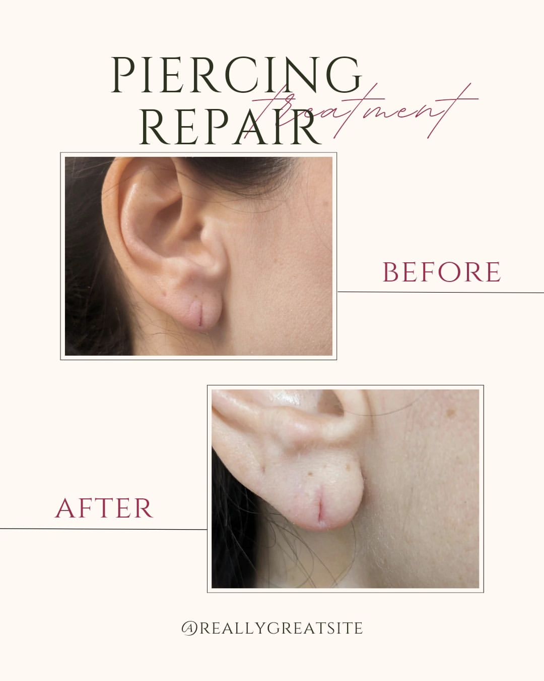 Before and after piercing repair treatment showing earlobe with closed piercing hole