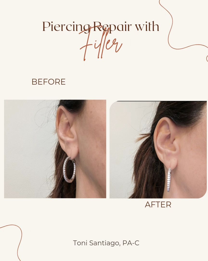 Before and after piercing repair with filler by Toni Santiago, PA-C showing enlarged earlobe compared to refined result