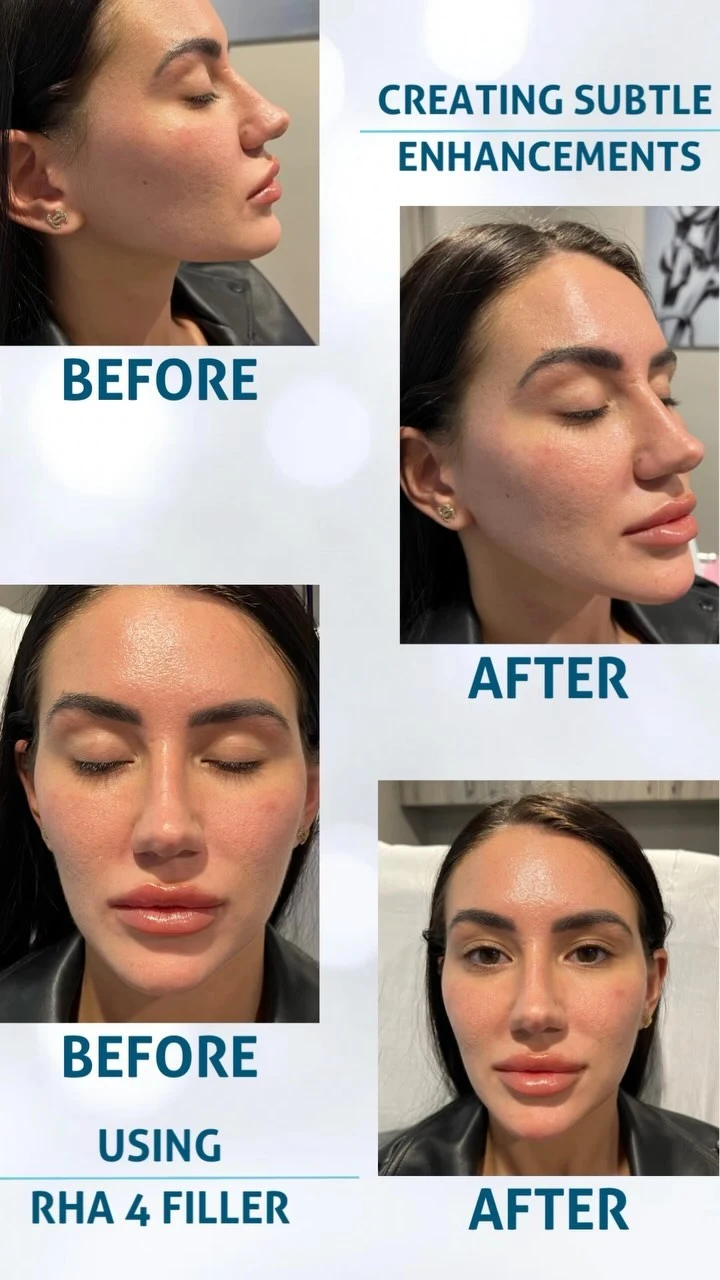 Before and after profile and frontal views showing lip and facial enhancement results with RHA 4 filler