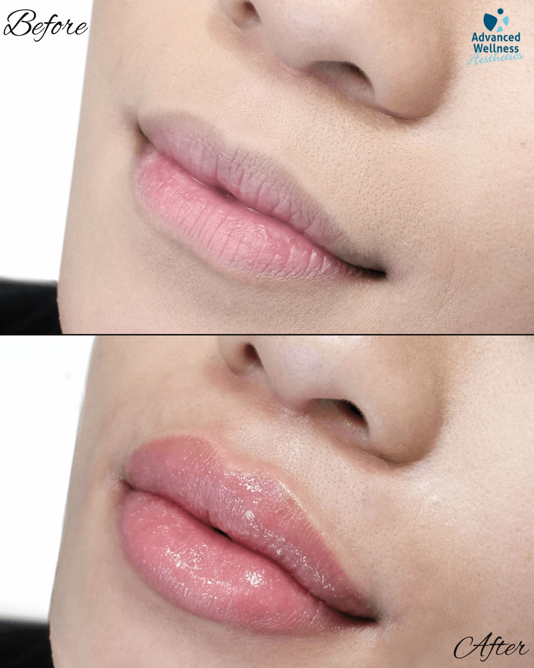 Before and after closeup of lips showing fuller lip volume from Revanesse lip filler treatment