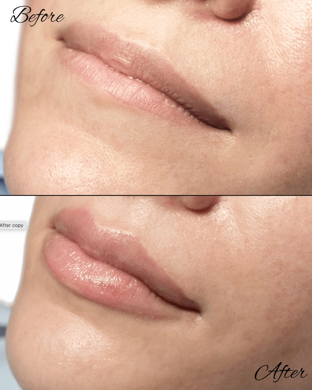 Before and after profile view of lips showing increased fullness from Revanesse lip filler treatment