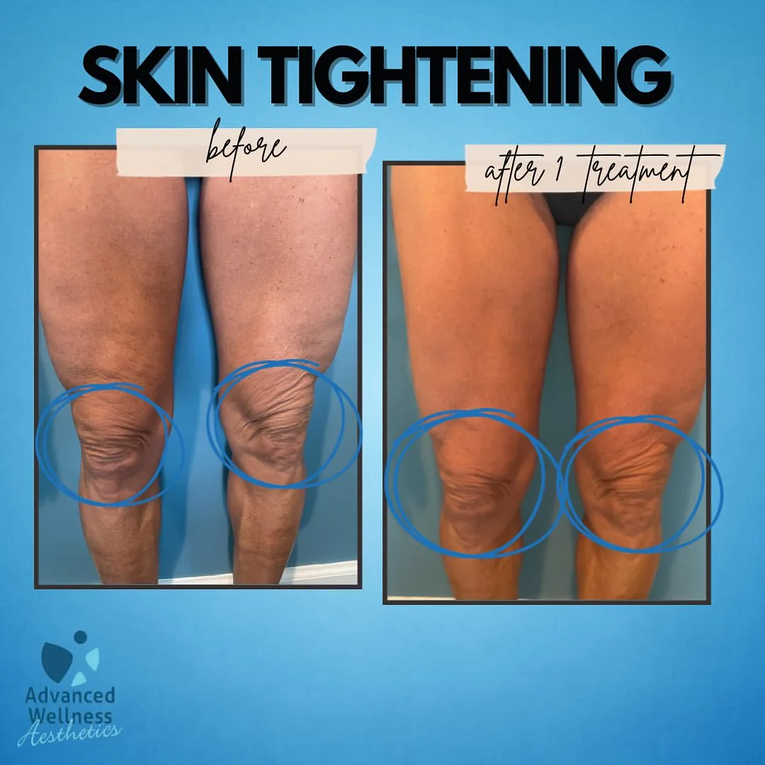 Skin tightening results on legs before and after one radiofrequency treatment, with areas of concern circled