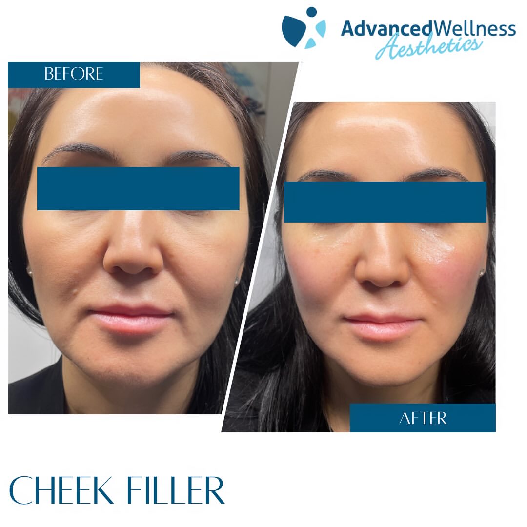 Before and after cheek filler treatment showing increased cheek definition and fullness