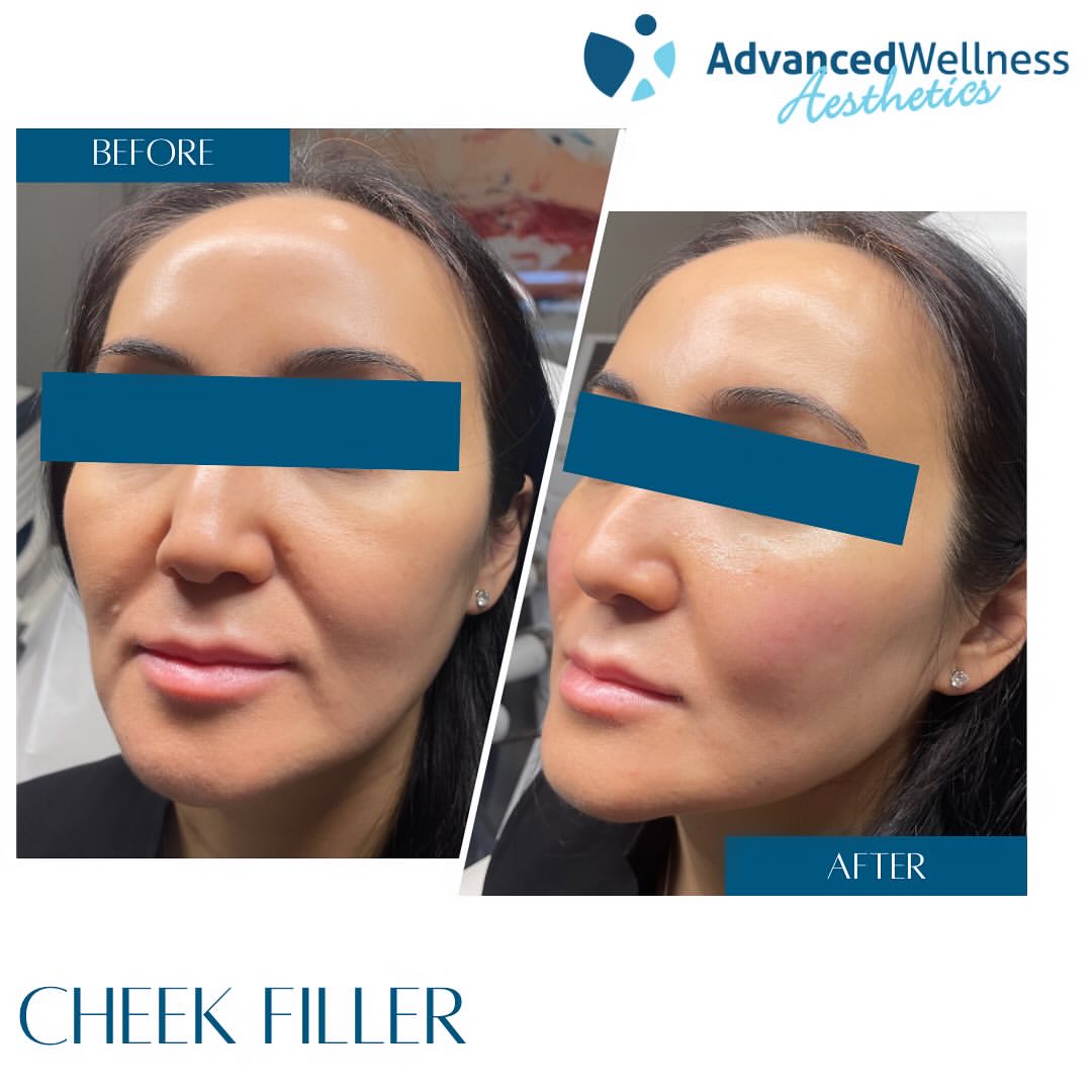 Before and after cheek filler showing enhanced cheekbone prominence from side profile