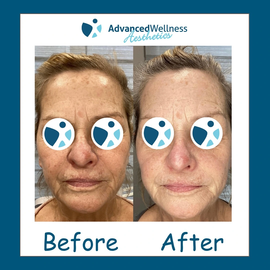 chemical peel treatment