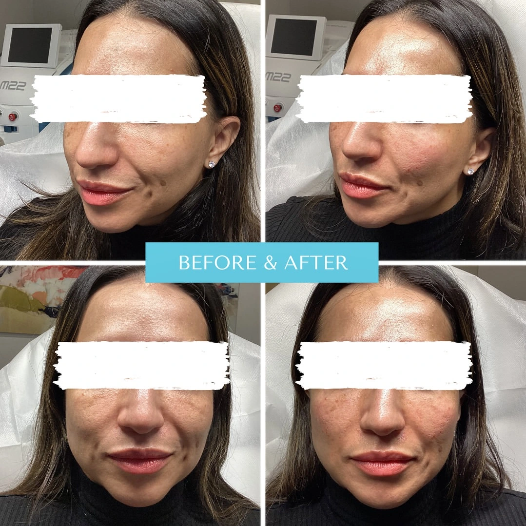 Before and after chin filler treatment showing four angles of patient's chin and lower face profile