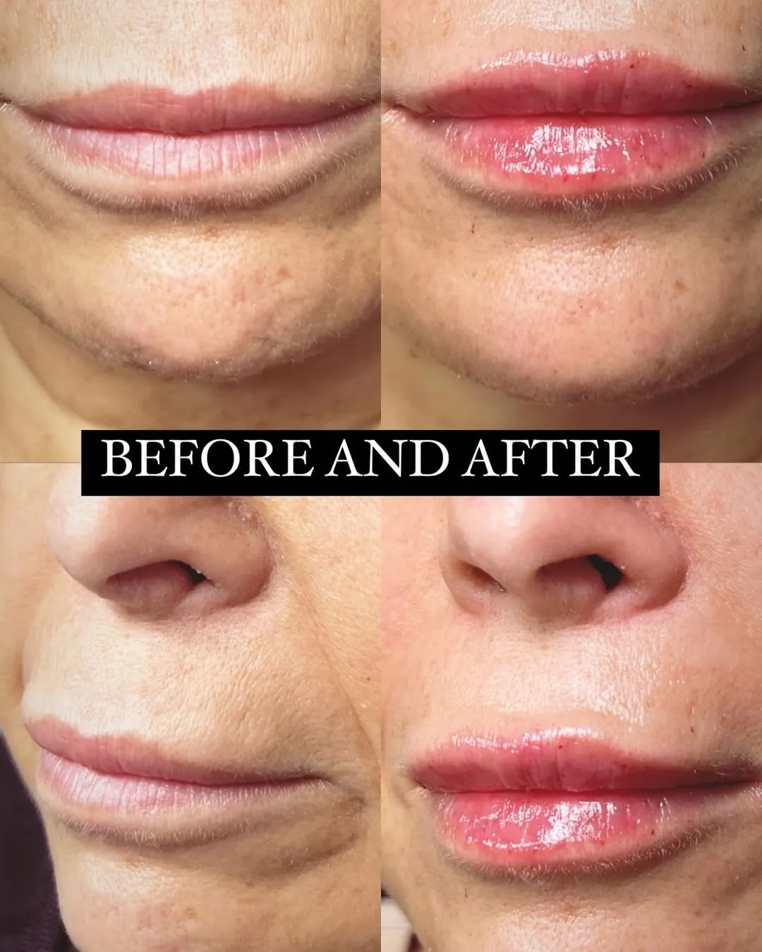 Before and after lip and nose filler showing increased lip volume and refined nasal contour