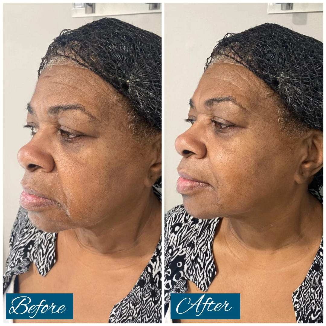 Before and after side profile showing improved facial contour and volume from filler treatment