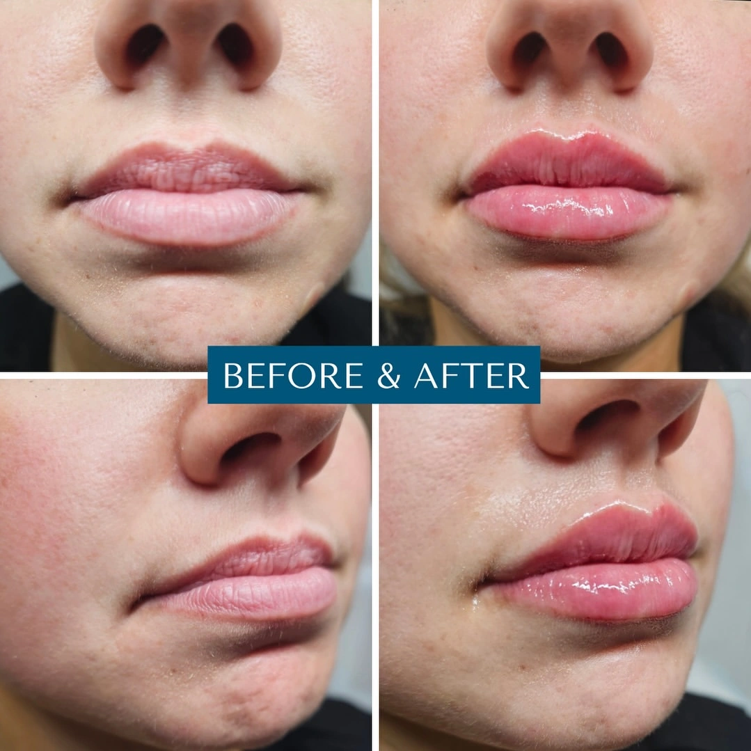 Before and after lip filler showing fuller lips with enhanced volume and definition