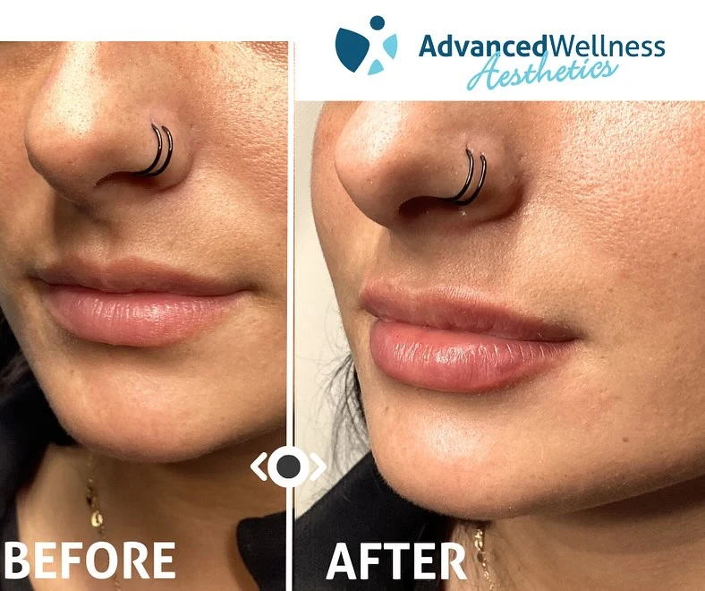Before and after lip filler results with Advanced Wellness Aesthetics logo, displaying enhanced lip volume