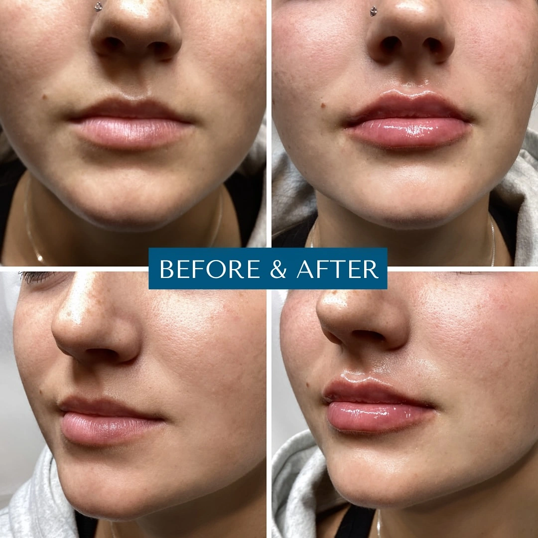 Before & After lip filler case showing fuller lips from frontal and side profile views