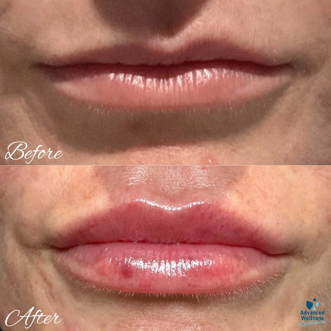Before and after lip filler treatment showing fuller lips with enhanced volume and definition