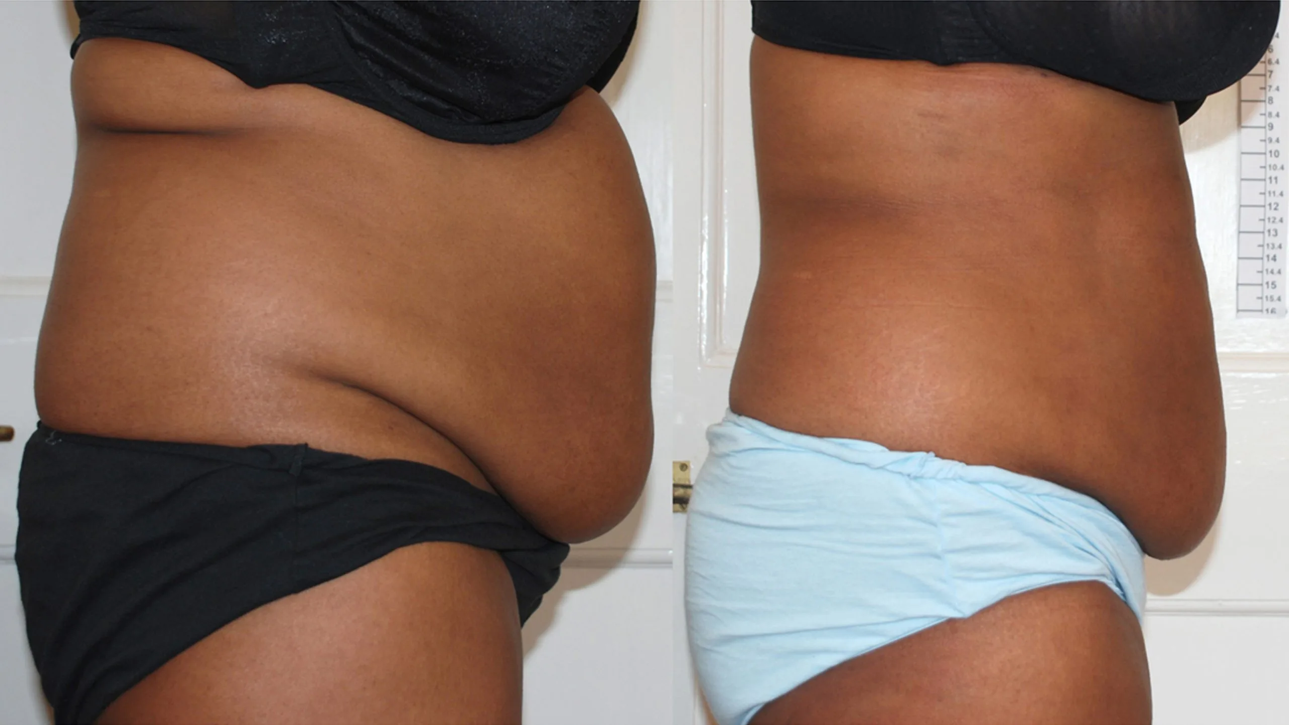 Before and after laser liposuction of abdomen showing flatter midsection