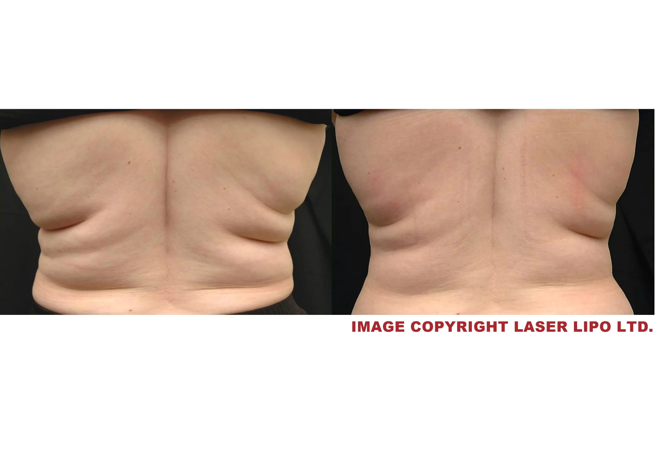 Before and after laser liposuction of lower back showing reduced skin laxity and improved definition