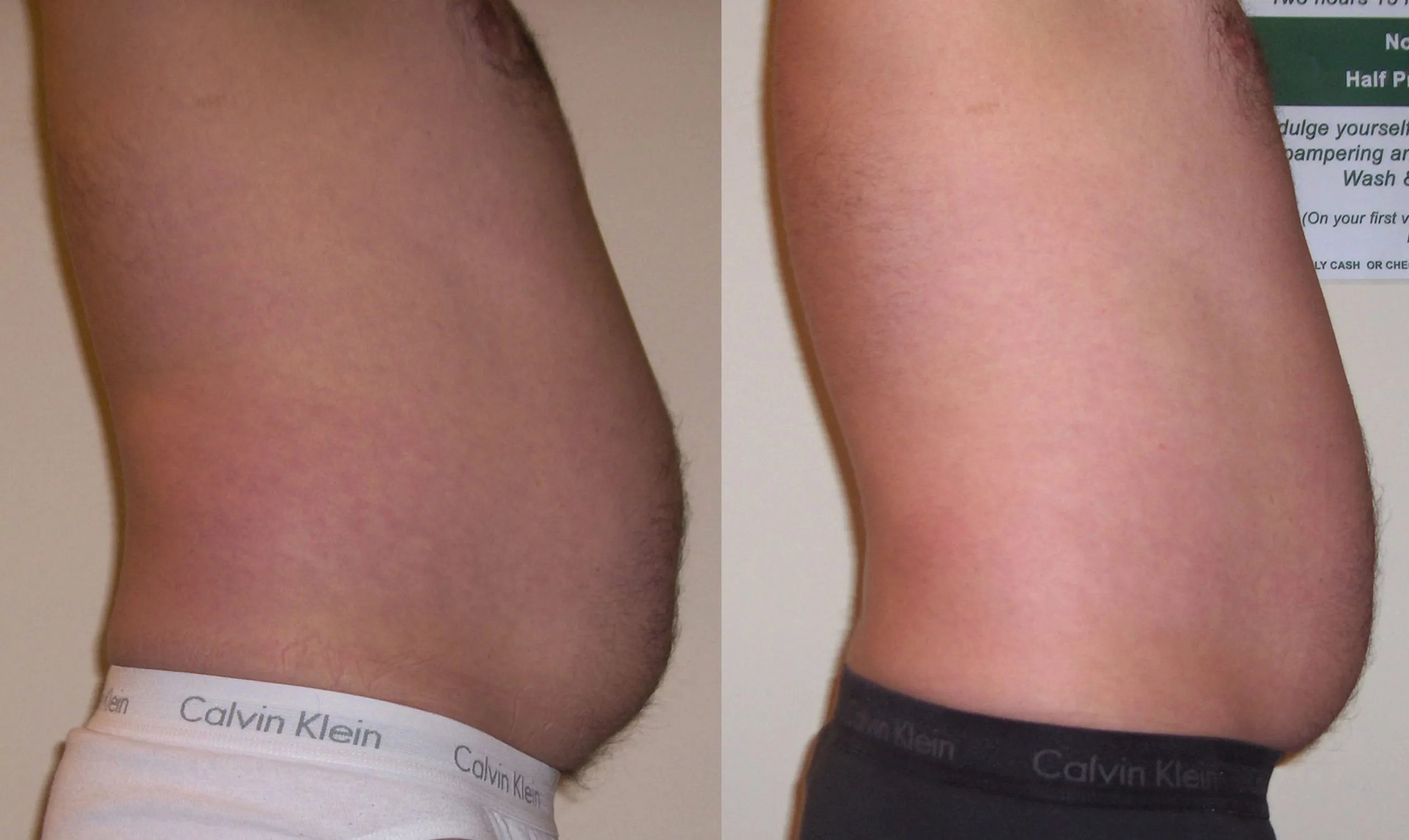 Before and after laser liposuction of male abdomen showing improved abdominal contour