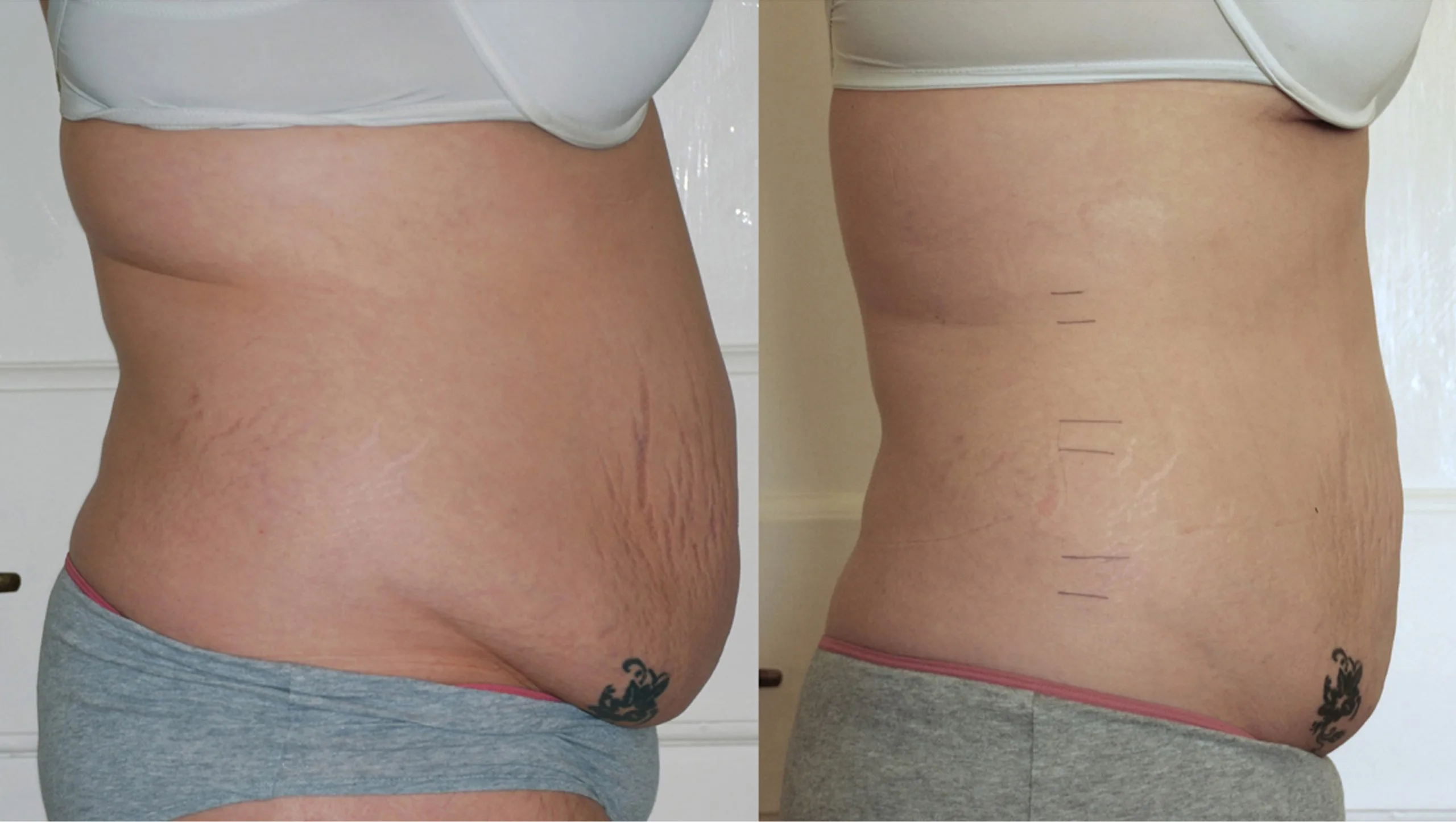 Before and after laser liposuction showing inch loss and tightened abdominal skin