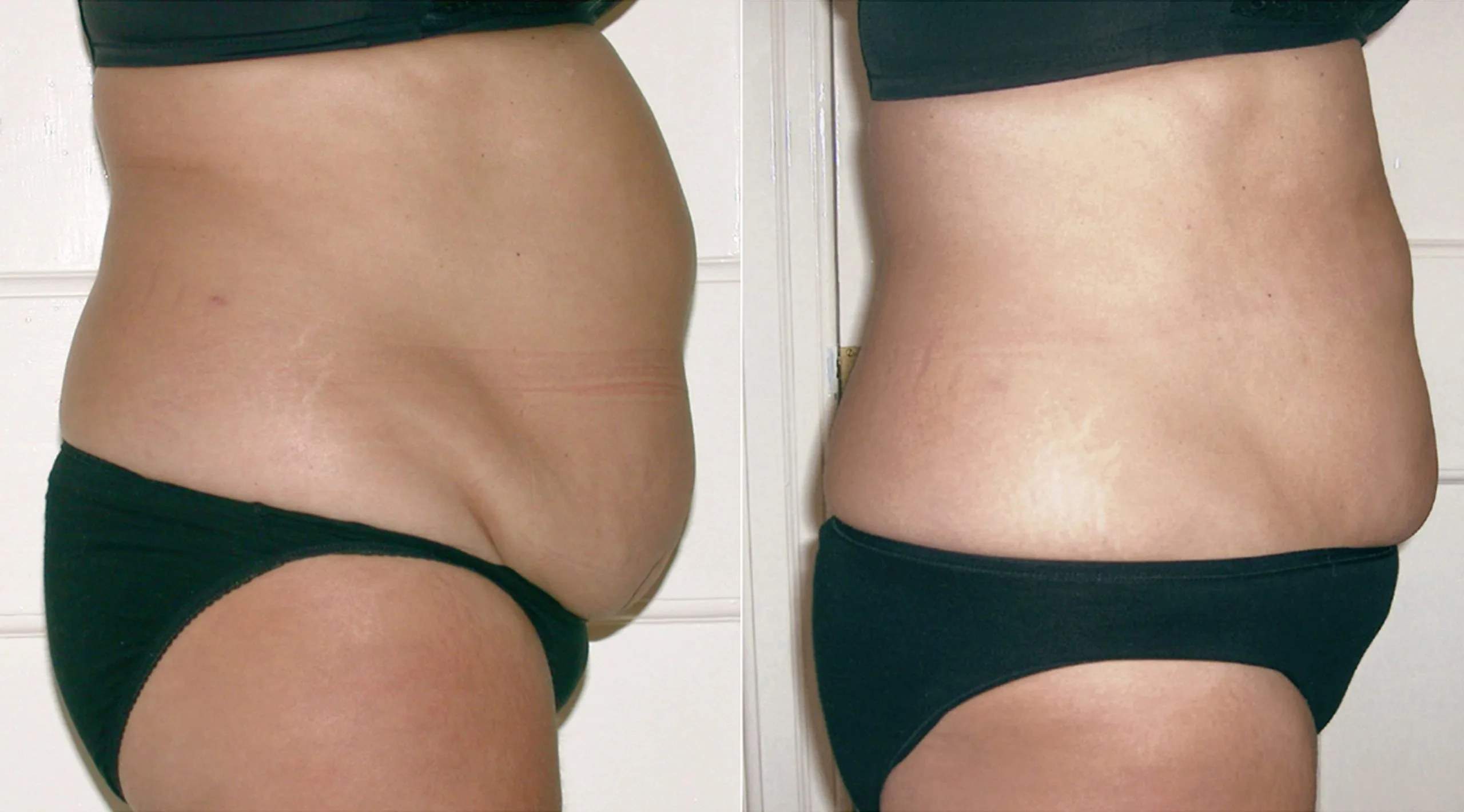 Before and after laser liposuction of abdomen showing reduced abdominal fullness and improved skin tone