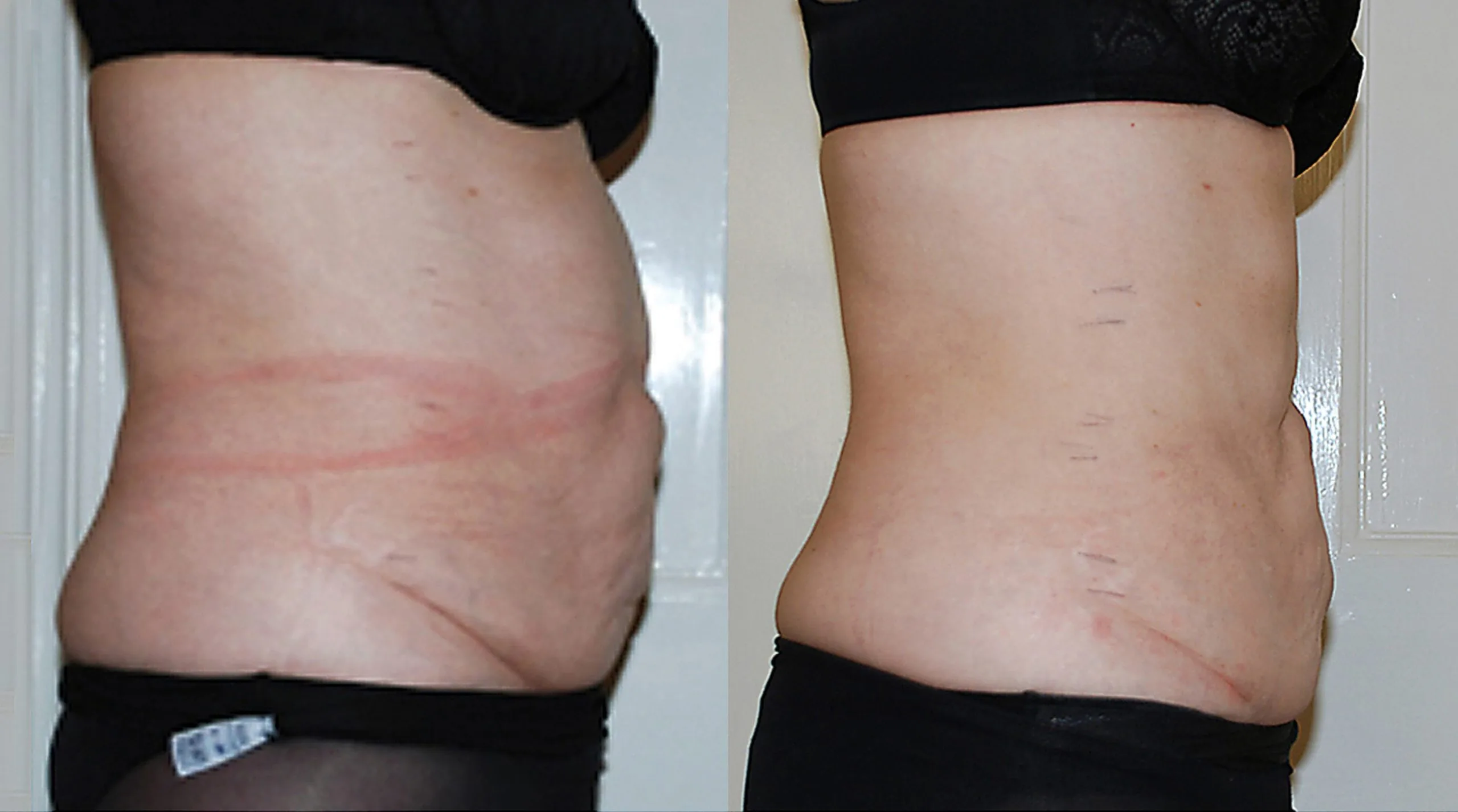 Before and after comparison of abdominal side view showing reduced midsection