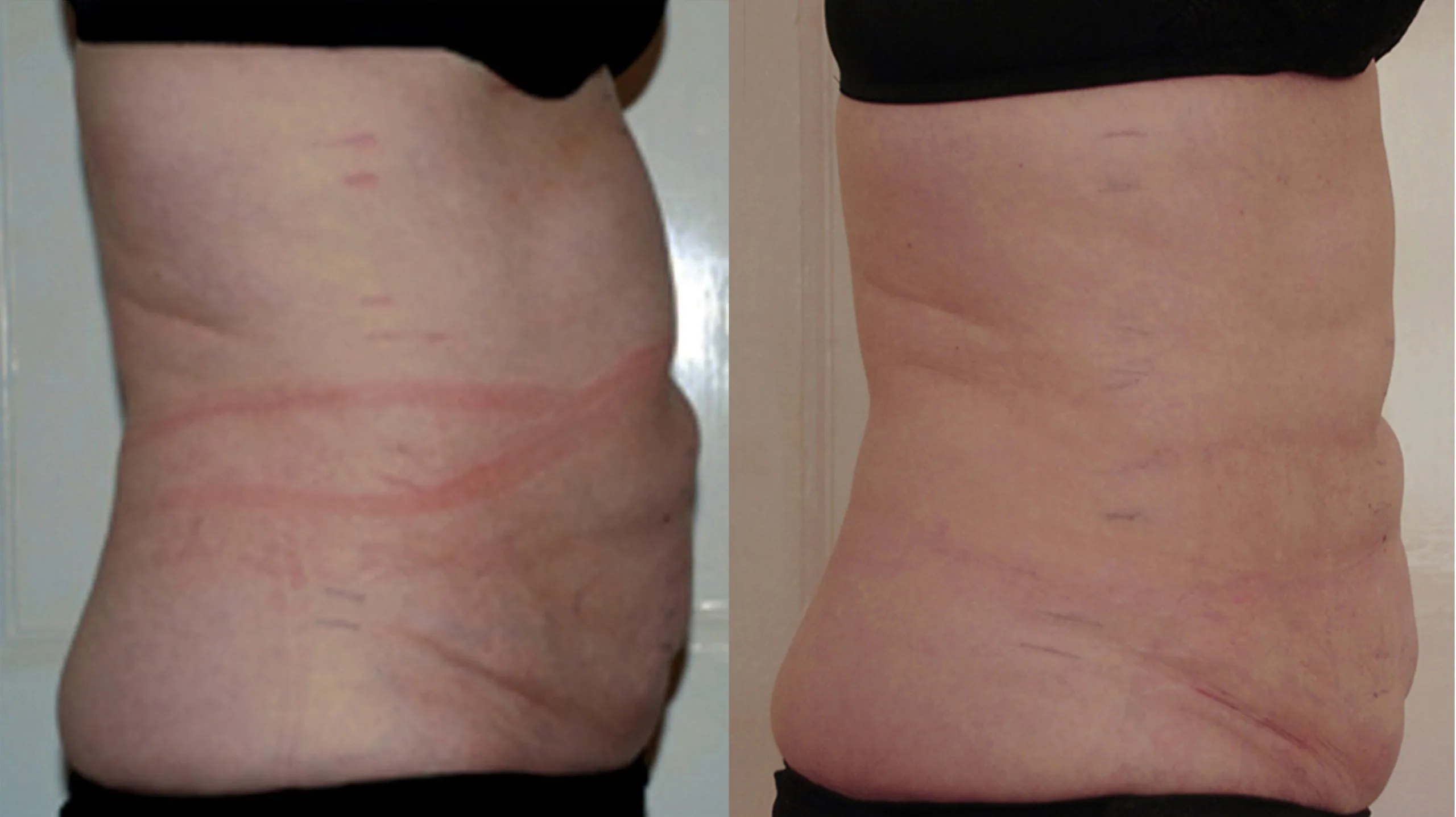 Before and after comparison of abdominal side view showing reduced waist and torso