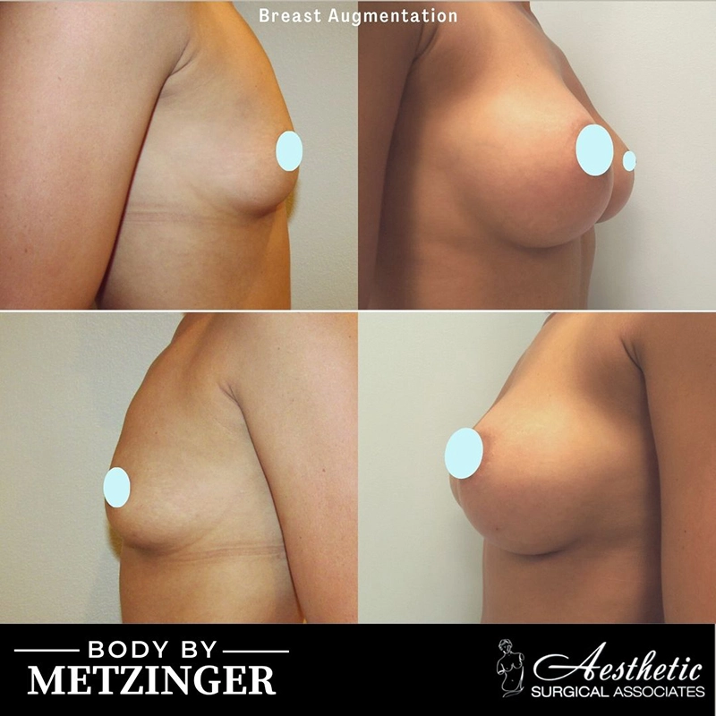 Multiple views before and after breast augmentation showing results from different angles