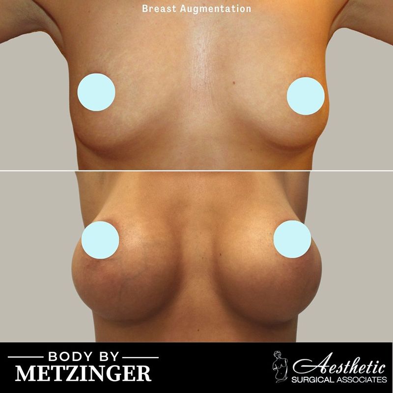Before and after breast augmentation results showing enhanced volume and projection