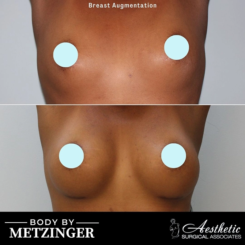 Before and After Gallery: Breast Augmentation B Banner