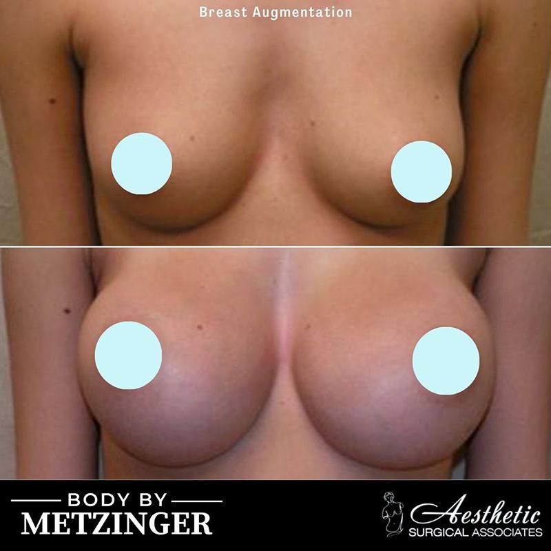 Before and After Gallery: Breast Augmentation C Banner