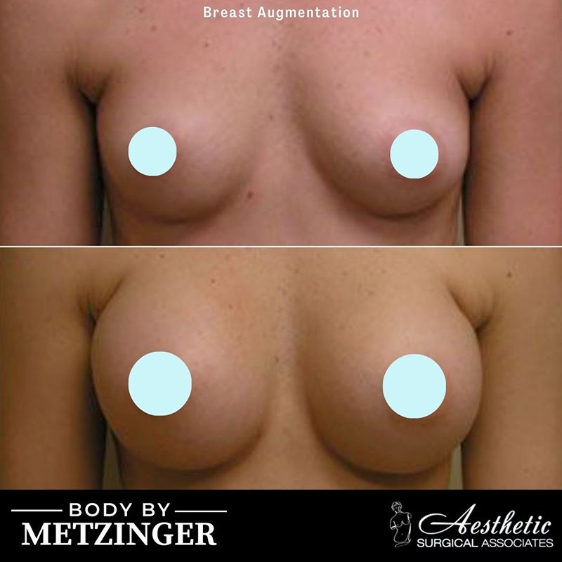 Before and After Gallery: Breast Augmentation D Banner