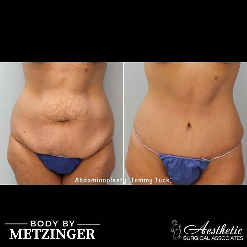Before and After Gallery: Tummy Tuck A Banner