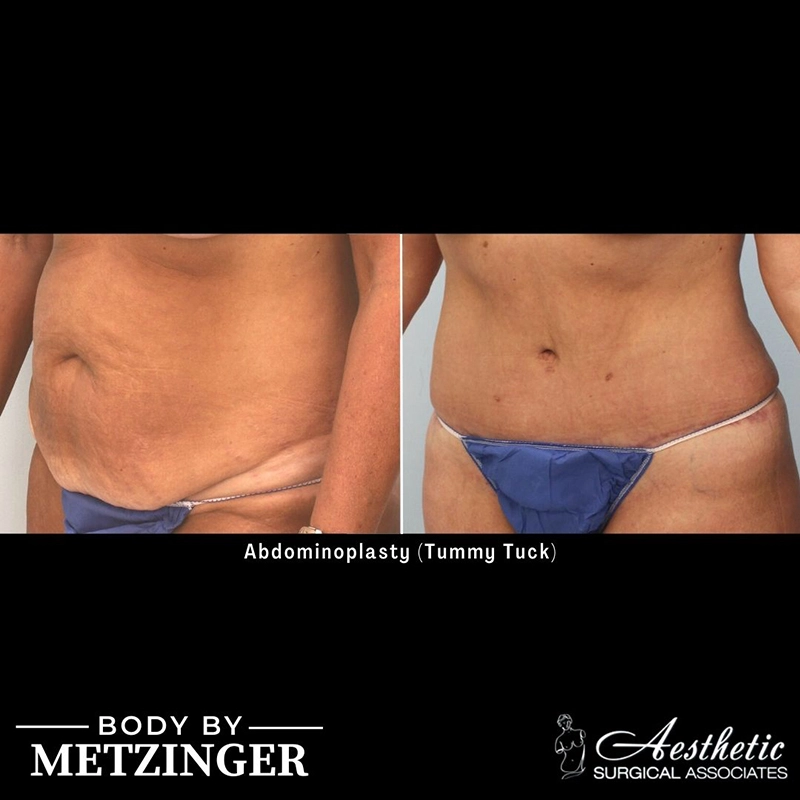 Before and After Gallery: Tummy Tuck B Banner
