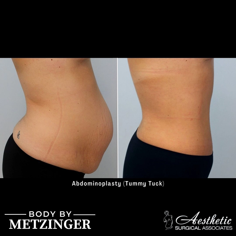 Before and After Gallery: Tummy Tuck C Banner