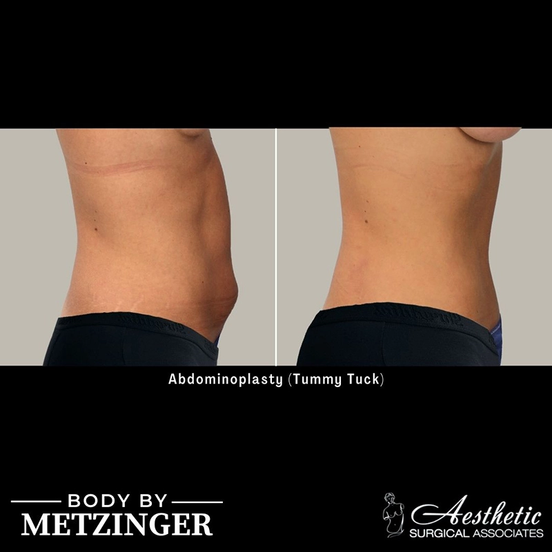 Before and After Gallery: Tummy Tuck D Banner