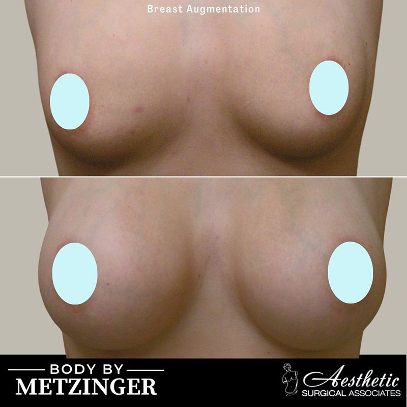 breast_augmentation_case12