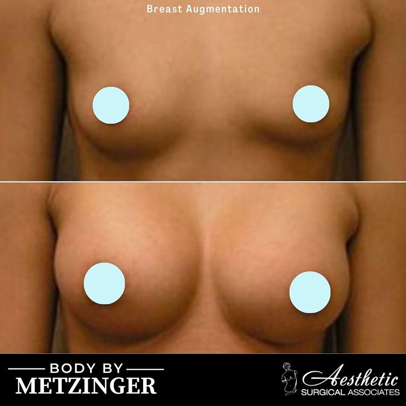 breast_augmentation_case20
