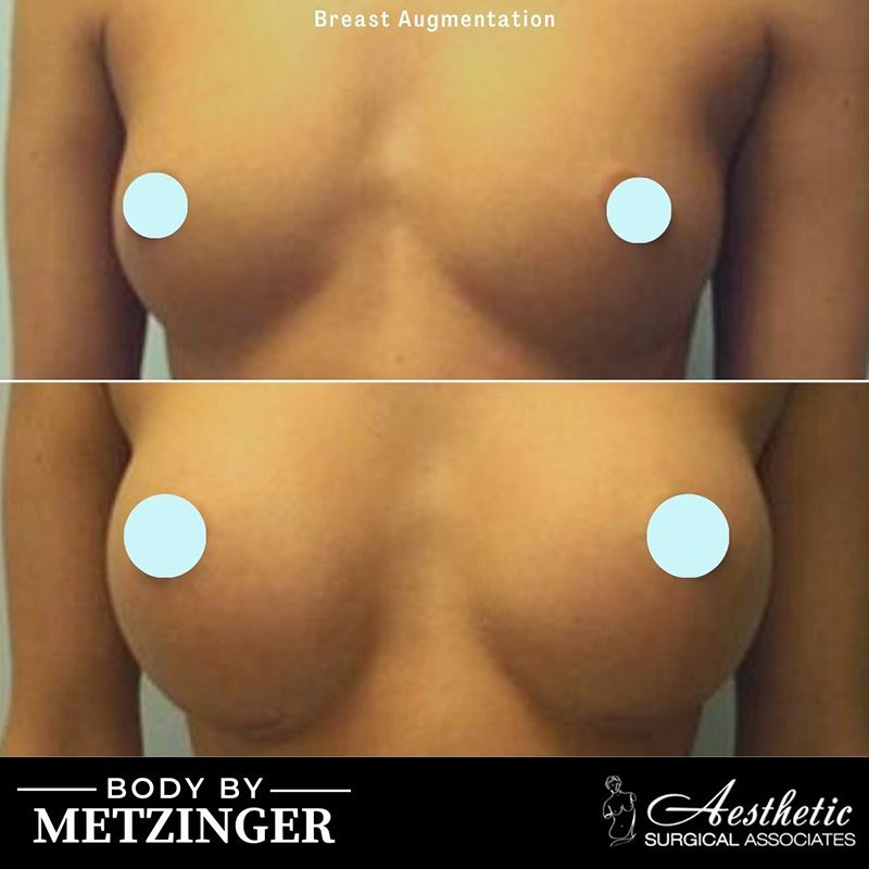Before and after breast augmentation comparison, front view, by Body by Metzinger
