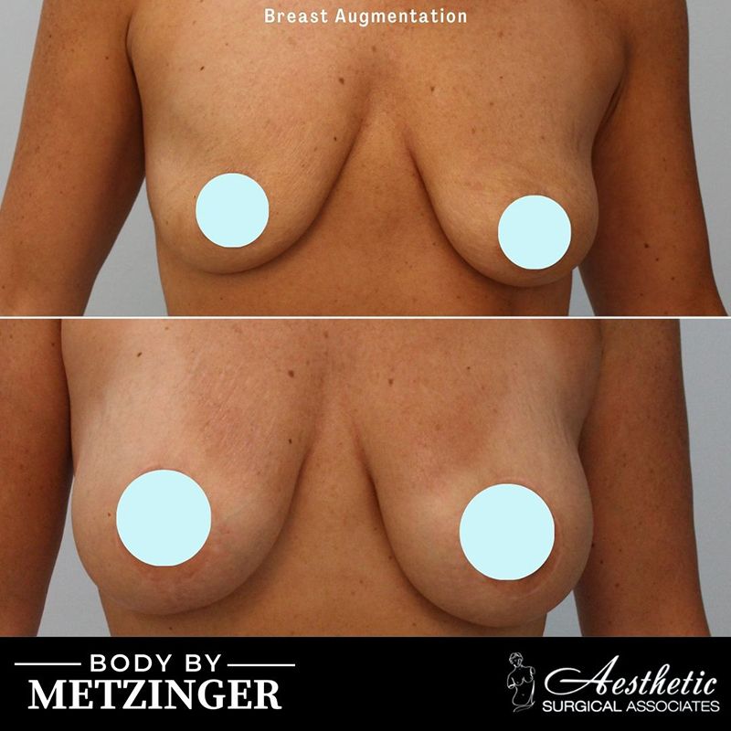 Before and after breast augmentation showing frontal view with patient privacy protection