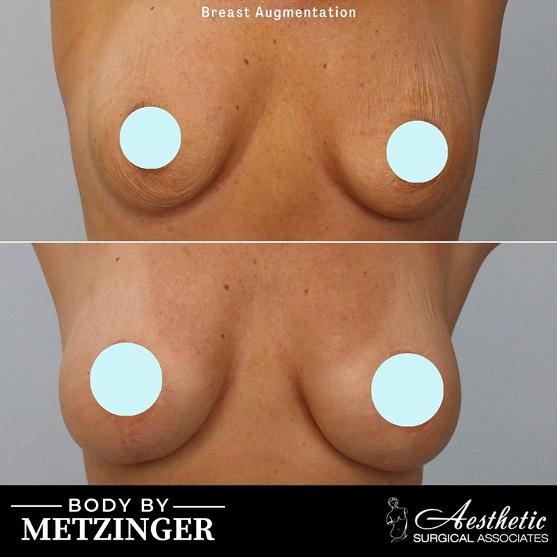 Breast augmentation before and after, frontal view displaying augmentation results