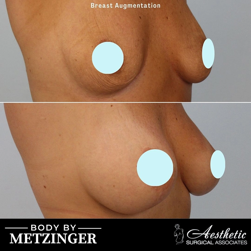 Breast augmentation before and after, three-quarter view showing contour improvement