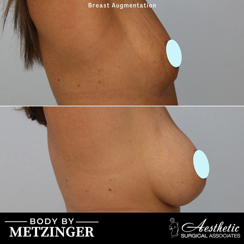 Breast augmentation before and after, side profile view demonstrating surgical results
